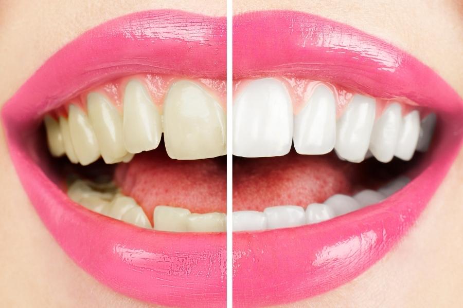 Whitening Hollywood Package photo by Uptodate Medicare Centre