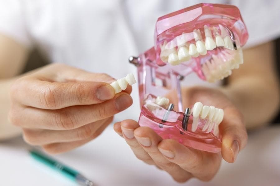 Dental Crowns and Bridges at Uptodate Medicare Centre in Dubai