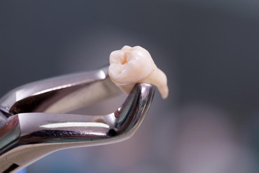Dental extractions and simple surgeries at Uptodate Medicare Centre in Dubai