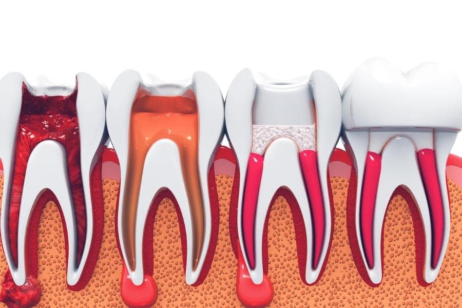 Dental root canal treatments at Uptodate Medicare Centre in Dubai
