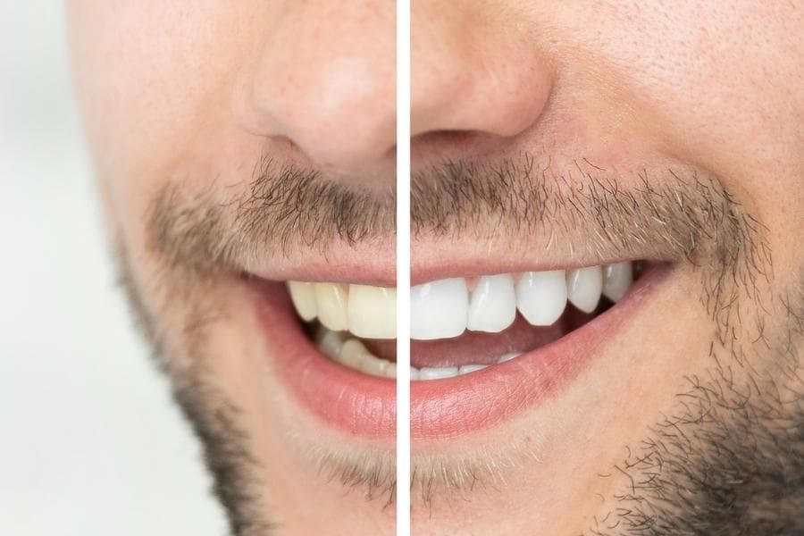 Teeth whitening at Uptodate Medicare Centre in Dubai